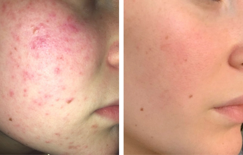 A photo showing a teenager with acne before and after treatment