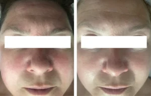 Before and after treatment photos of a lady with perimenopausal rosacea