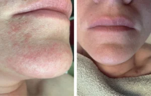 Before and after treatment photos of a teen with perioral dermatitis on the chin