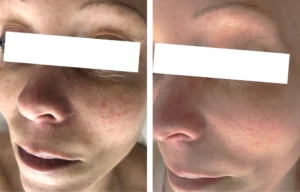 Before and after treatment photos of a lady with redness from sun damage and medication.