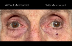 Before and after treatment photos of a lady who received treatment for loss of firmness under the eyes