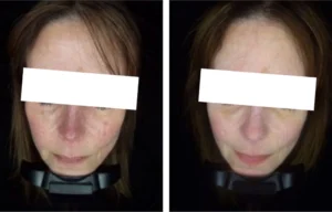 Before and after treatment photos of a lady with redness around the nose