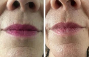 Before and after treatment photos of Neurotris microcurrent sessions to plump the lips