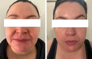 Before and after treatment photos of a lady who had sun damage to the face. The after photo is following LED light therapy treatment